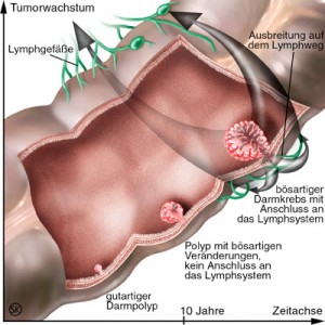 adenom-carcinom-sequenz-ad